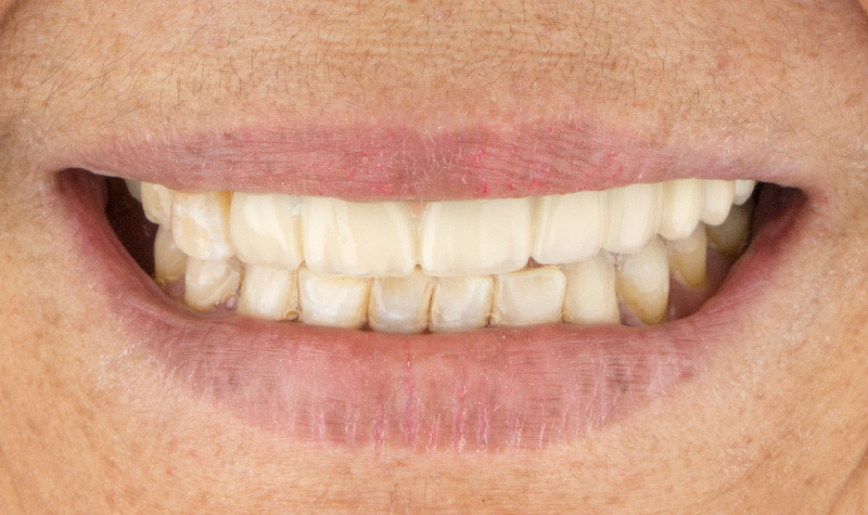 Rehabilitación oral completa Clínica Vallegrande