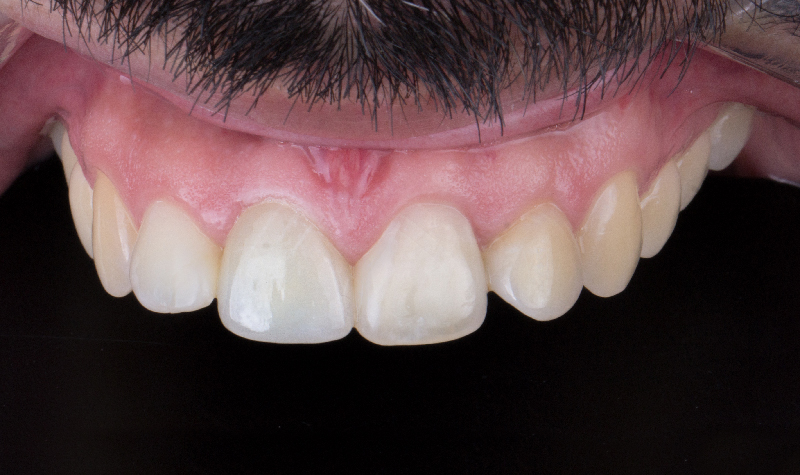 Rehabilitación oral completa Clínica Vallegrande