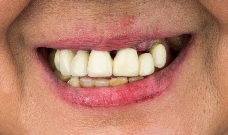 Rehabilitación oral completa Clínica Vallegrande