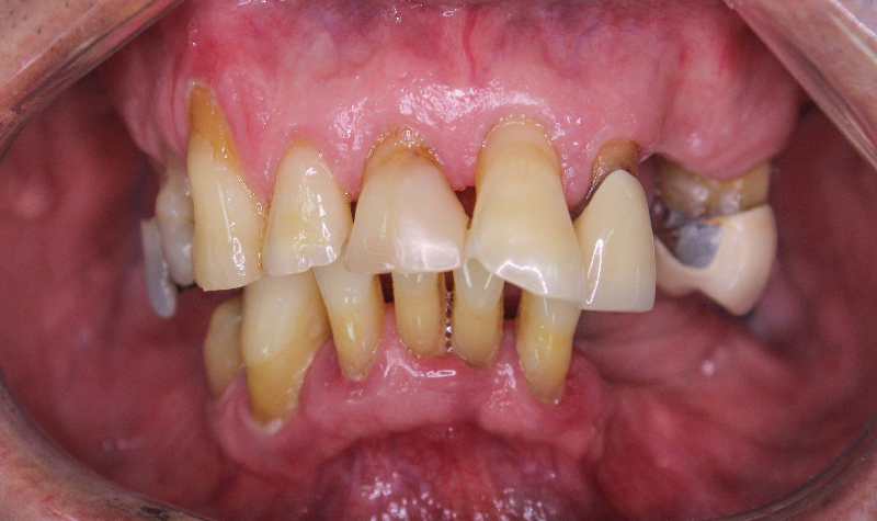 Rehabilitación oral completa Clínica Vallegrande