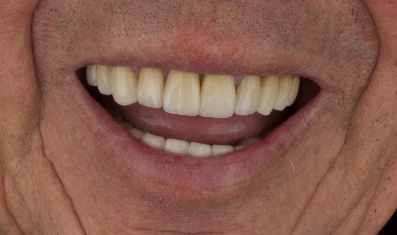 Rehabilitación oral completa Clínica Vallegrande