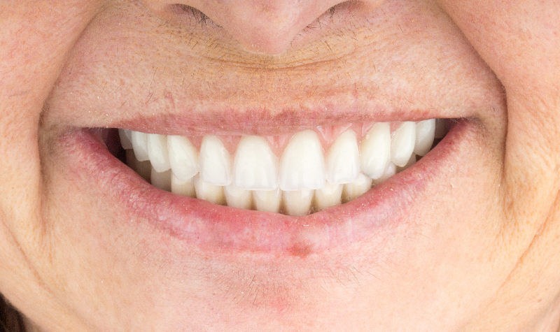 Rehabilitación oral completa Clínica Vallegrande