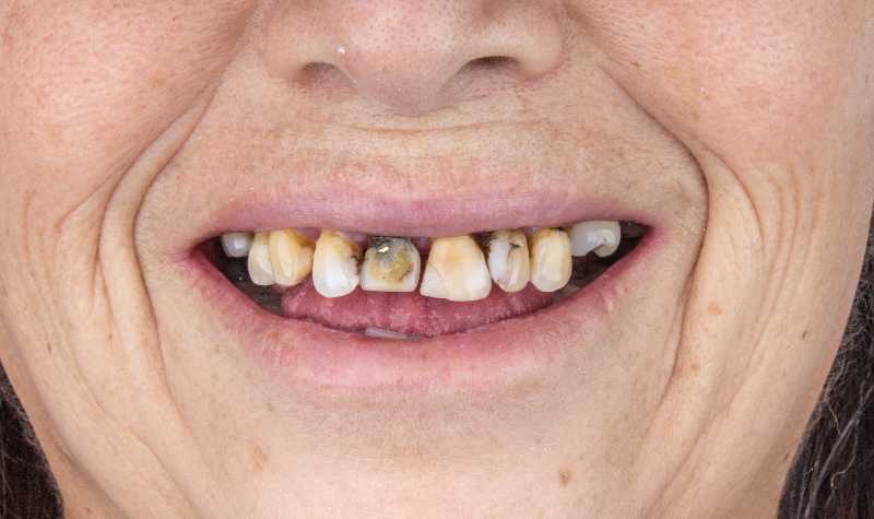 Rehabilitación oral completa Clínica Vallegrande