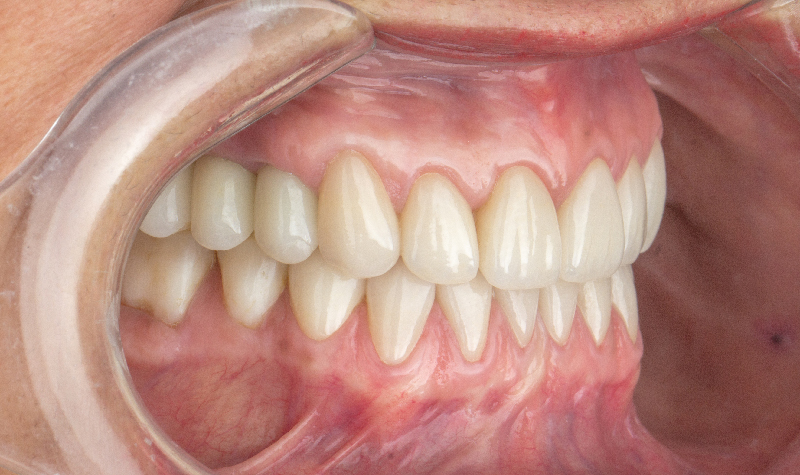 Rehabilitación Oral total Clínica Vallegrande