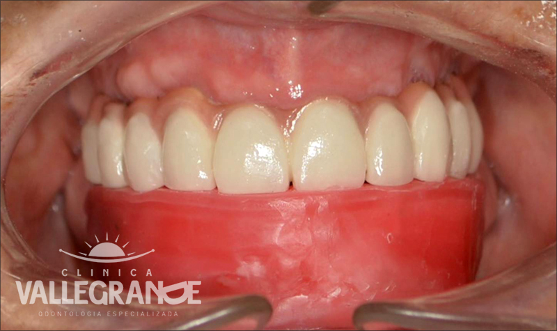 Protesis completa fija sobre implantes Clínica Vallegrande
