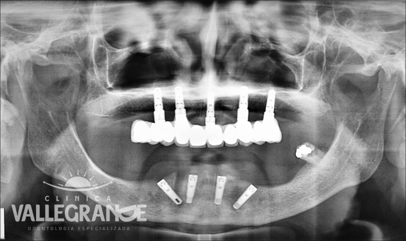 Protesis completa fija sobre implantes Clínica Vallegrande