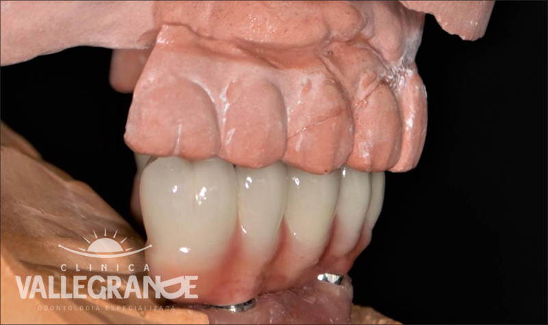 Protesis completa fija sobre implantes Clínica Vallegrande