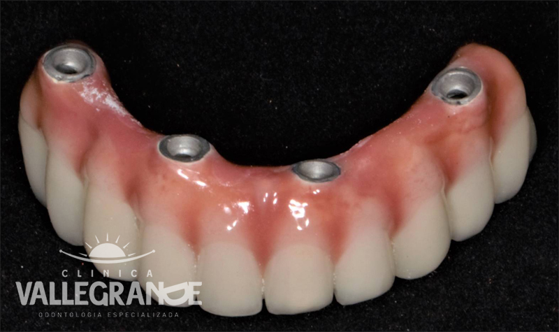 Protesis completa fija sobre implantes Clínica Vallegrande