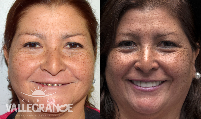 Estética Dental Clínica Vallegrande